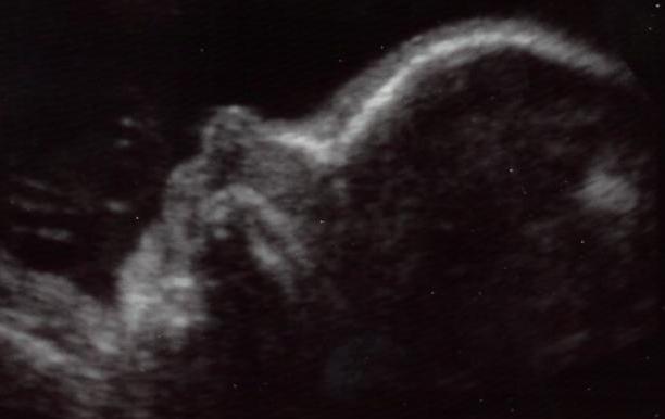 babypmsn.jpg